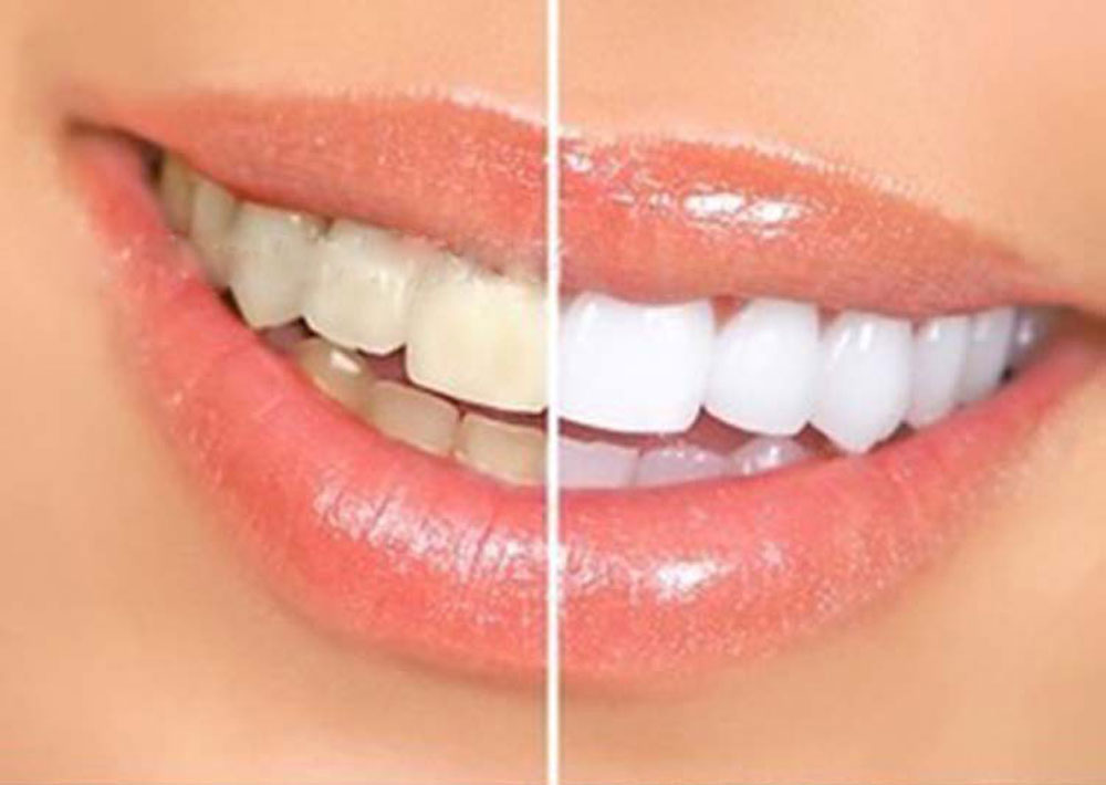 Teeth Bleaching Whitening Pen Dental Scaler